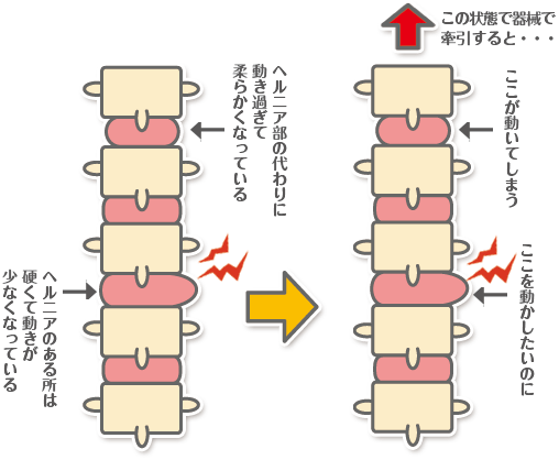 病院で牽引治療を受けた場合