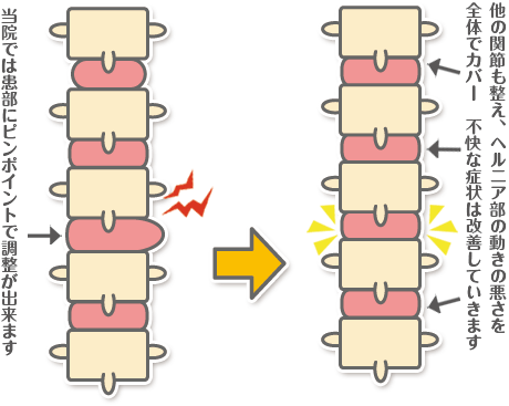 ヘルニア施術解説