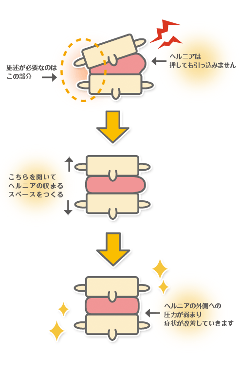 ヘルニアが正常な位置に治まっていくスペースを先につくる