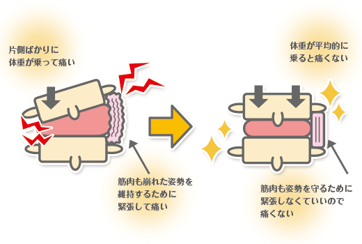 腰痛の起こるメカニズム