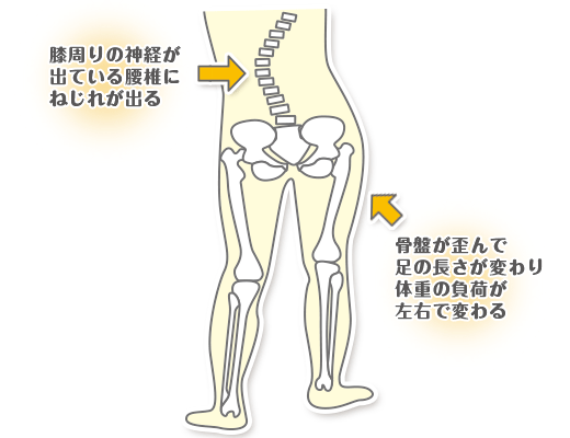 膝の歪みを説明するイラスト