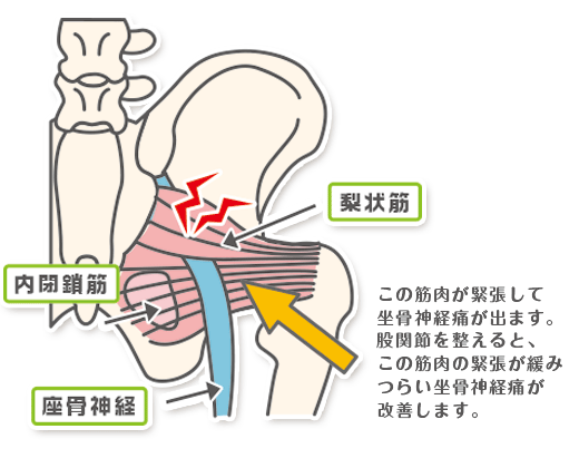 坐骨神経痛と股関節