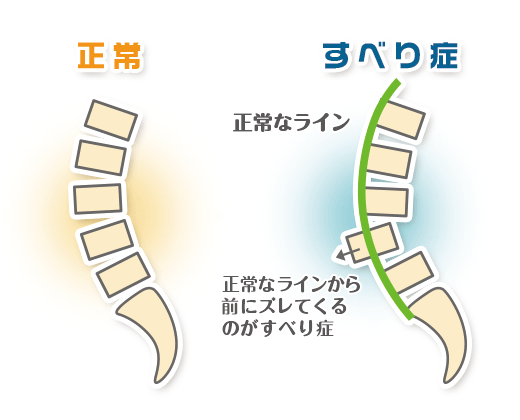 すべり症の説明