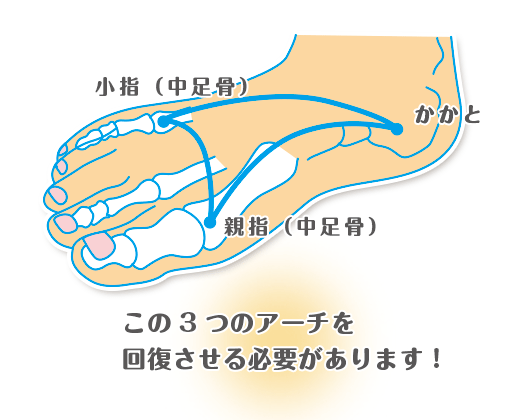 足のアーチ回復のイラスト