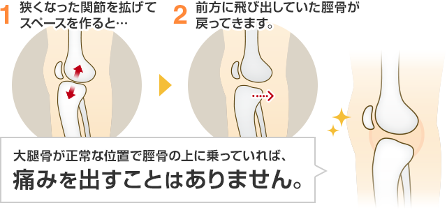 狭くなった関節を広げてスペースを作ると…前方に飛び出していた脛骨が戻ってきます。大腿骨が正常な位置で脛骨の上に乗っていれば、 痛みを出すことはありません。