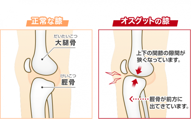 正常な膝とオスグットの膝