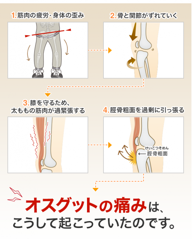 オスグットの痛みは、こうして起こっていたのです。