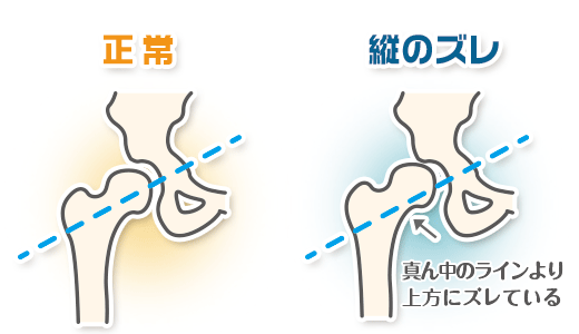 股関節の痛みの説明